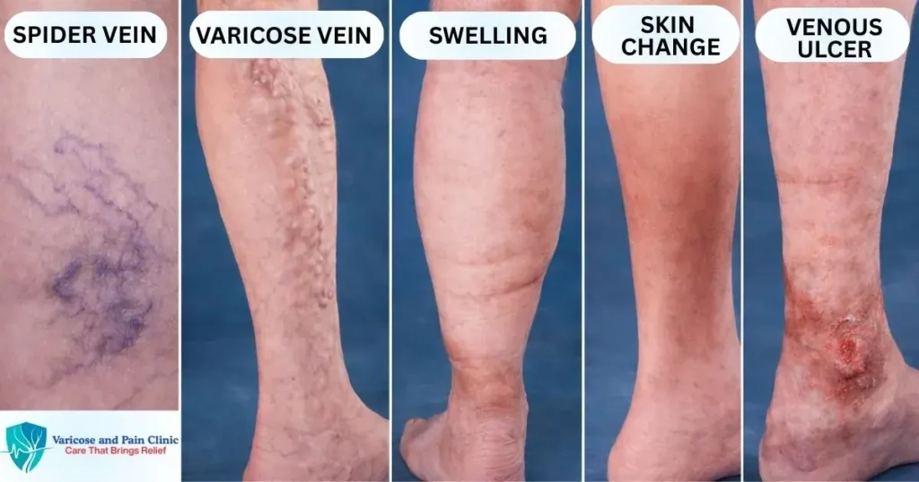 Stages of varicose veins showing spider veins, varicose veins, swelling, skin changes, and venous ulcers treated with Laser Treatment for Legs in Jaipur.