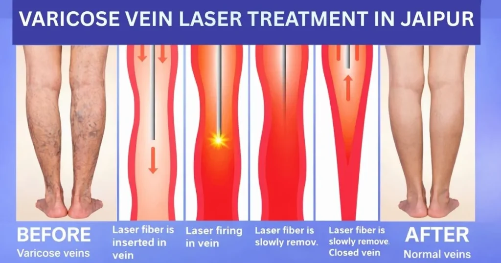 SPIDER VEIN 2 1 1024x538